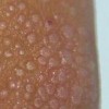 多发性口腔扁平苔藓图片