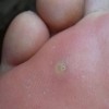 鸡眼产生的具体病因是什么