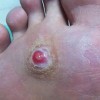 青岛鸡眼多发于哪些因素，怎样治疗呢