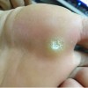鸡眼的具体症状表现