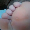 鸡眼膏的疗效怎样