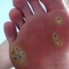 鸡眼的病理