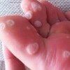 除掉鸡眼的措施是什么