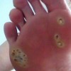 帮您彻底的了解鸡眼