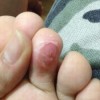 鸡眼