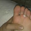 鸡眼该怎么医疗
