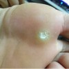 青岛鸡眼常见的治疗的手法