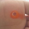 青岛鸡眼怎么治疗最好
