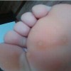青岛鸡眼治疗