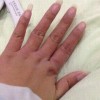 医生解析冻疮预防及治疗