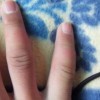 预防手冻疮的措施