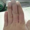 冬季该怎样预防冻疮的出现