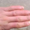 预防和治疗冻疮的办法有什么