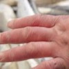 易引起冻疮的原因 冬季预防冻疮有妙方