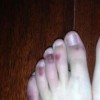 什么是冻疮 它的病因和表现症状有哪些
