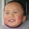 冻疮的病因有什么