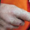 应提前预防冻疮发生