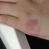 冻疮的具体症状都有什么呢