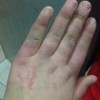 手上生了冻疮怎么办