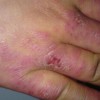 冻疮是怎样形成的