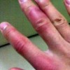 中医治疗冻疮比较正确的手法是什么