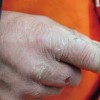 冬天发生冻疮可以如何治疗