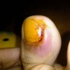 甲沟炎的保健和护理