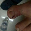 甲沟炎的手术后护理