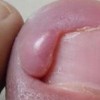 甲沟炎的日常护理