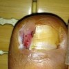 甲沟炎患者如何科学护理