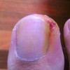 儿童预防甲沟炎需做哪些事项
