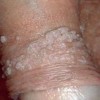 护理尖锐湿疣有哪些方面