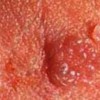 -导致尖锐湿疣病毒侵入的的具体因素