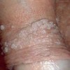 尖锐湿疣初期有哪些表现