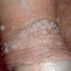 感染尖锐湿疣后有什么表现