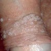尖锐湿疣的初期病情表现有哪些