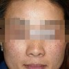 预防雀斑我坚持九大措施