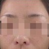 怎样预防雀斑的出现