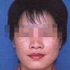 怎样的预防雀斑
