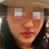 食物可以预防雀斑