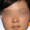 预防雀斑的生成有什么措施