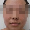 预防雀斑的措施都包括什么呢