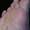 脚气患者会有什么症状出现呢