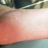 脚气有哪些表现特点