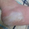 脚底长水泡很痒