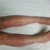 过敏性紫癜食疗食谱大全