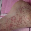 春季要预防过敏性紫癜