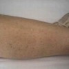 腹型过敏性紫癜