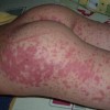 过敏性紫癜如何进行突发急救