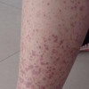 过敏性紫癜患者需注意